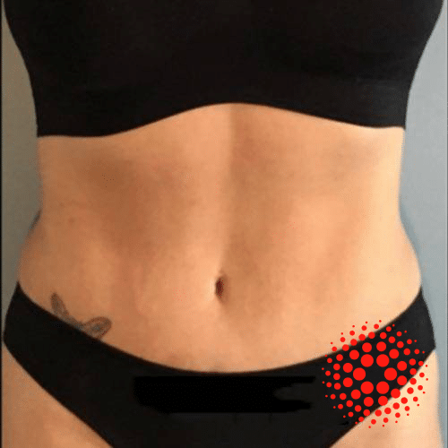 NUSHAPE Lipo Wrap Customer Success Before & After Stories