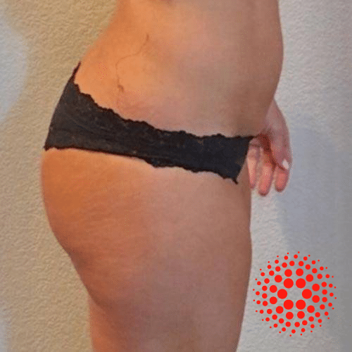 NUSHAPE Lipo Wrap Customer Success Before & After Stories